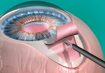 glaucoma_surgical_therapy_img