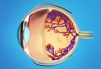 retinopathy_of_prematurity_img