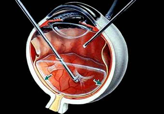 vitreoretinal_surgery